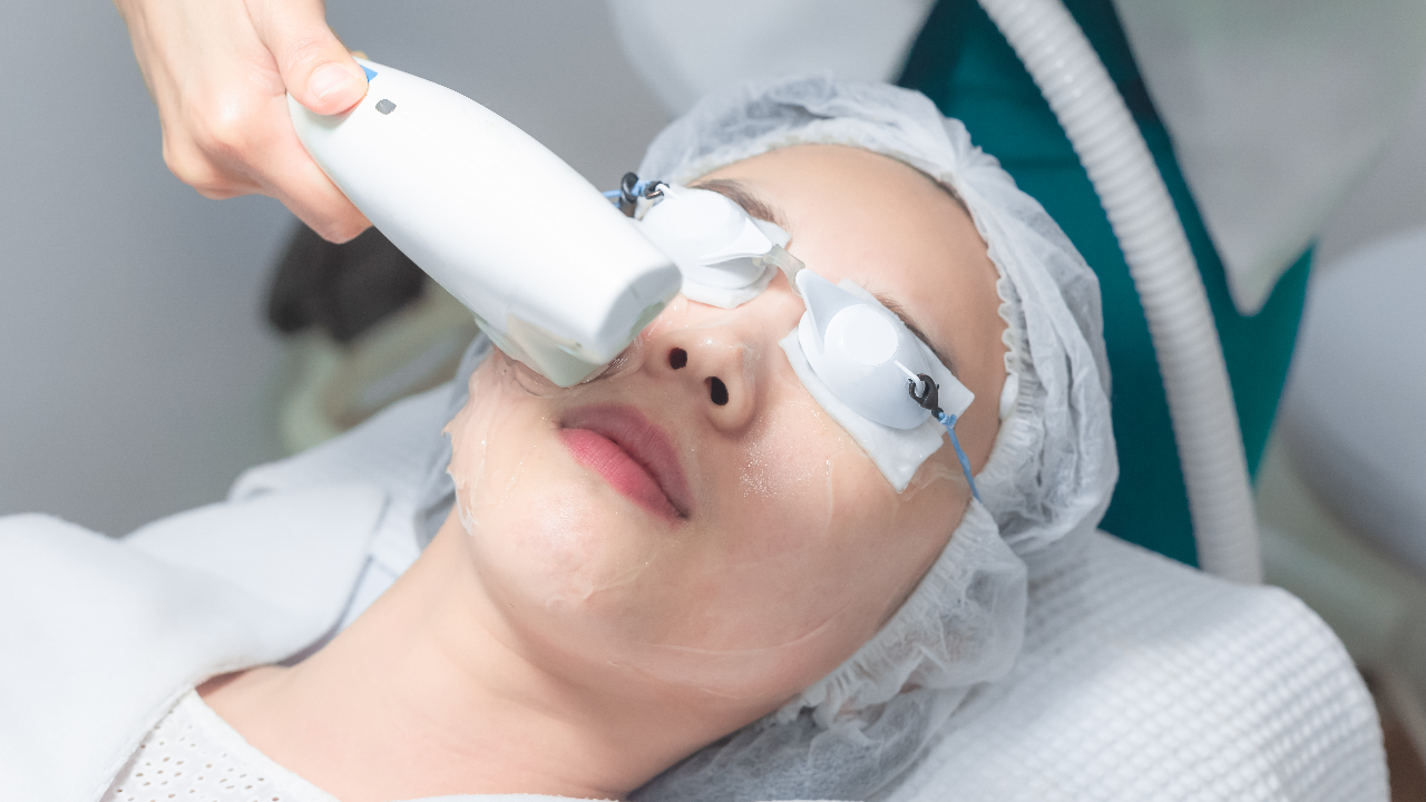 เลเซอร์รักษาสิว ยอดฮิต