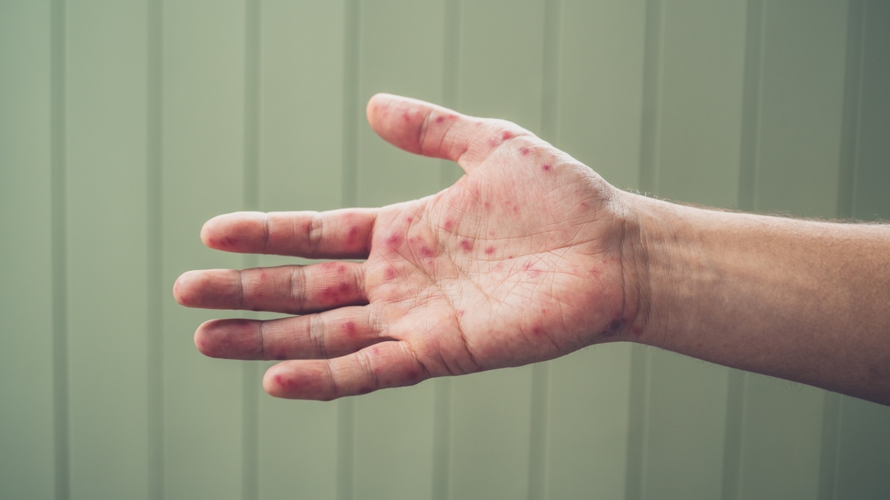 ศูนย์จีโนมฯ ยัน "ไข้หวัดมะเขือเทศ" ระบาดในอินเดีย ไม่ใช่ไวรัสใหม่ รักษาหายได้