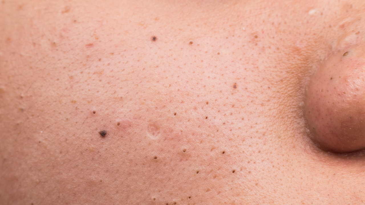 สวยสูตรอันตราย "หมอแล็บแพนด้า" เตือนอย่านำกาวทาหน้าลอกสิวเสี้ยน