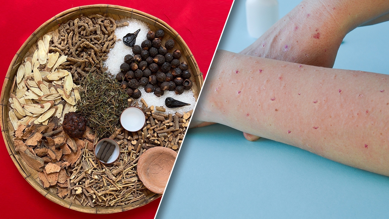 สูตรตำรับยาสมุนไพรไทย 4 ขนาน อีกหนึ่งทางเลือก บรรเทาอาการฝีดาษลิง