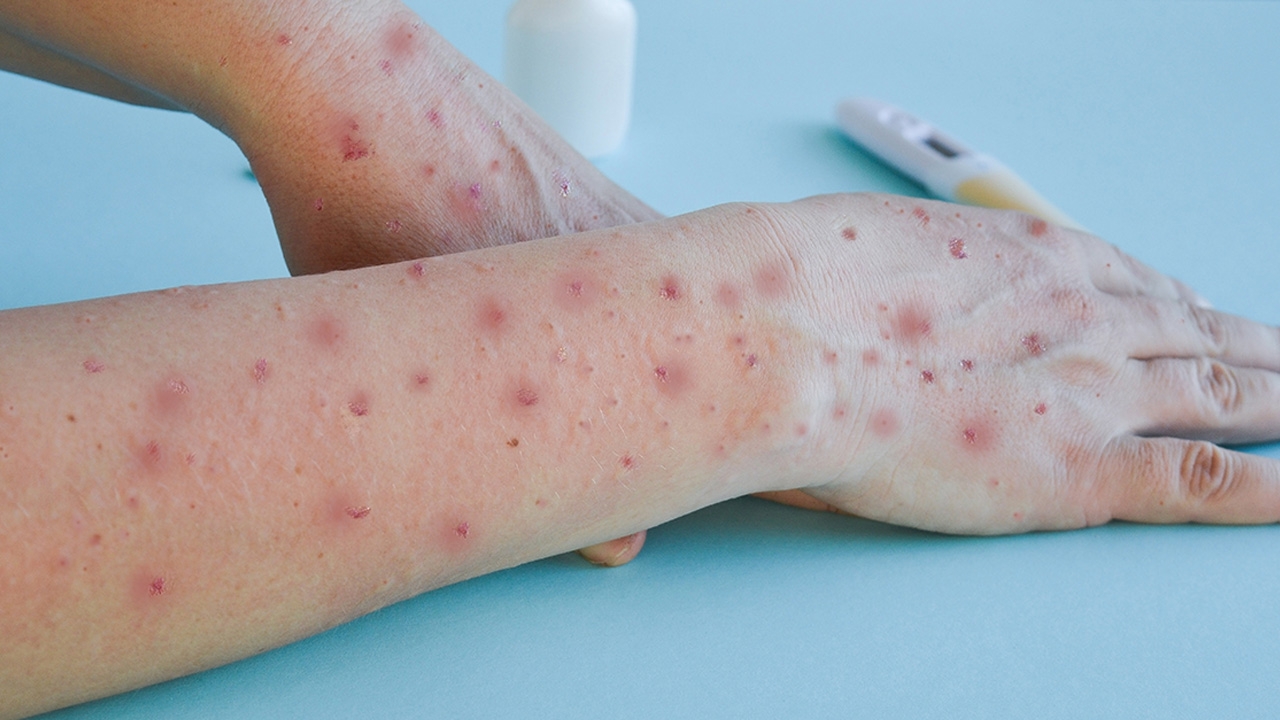รับมืออย่างไรกับ โรคฝีดาษลิง (Monkeypox)