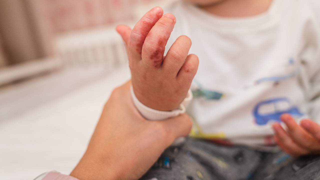 รู้จัก อาการและวิธีรักษา "โรคมือเท้าปาก" โรคยอดฮิตมาพร้อมฝน