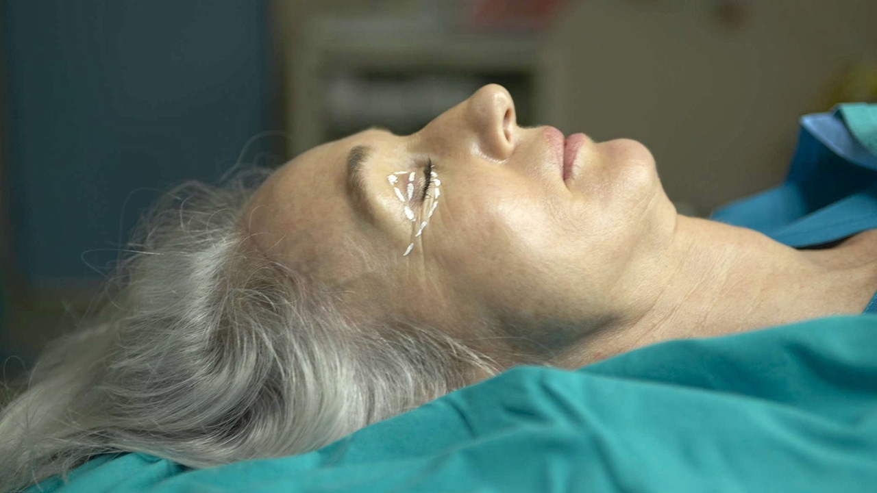 หนังตาตก (Ptosis or Drooping Eyelid) ต้นเหตุผู้สูงอายุ...มองเห็นลดลง