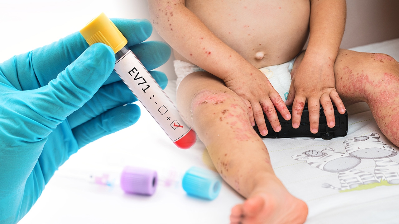 รู้จัก “เชื้อ EV 71” ในโรคมือเท้าปาก อันตรายถึงชีวิต ป้องกันได้อย่างไร