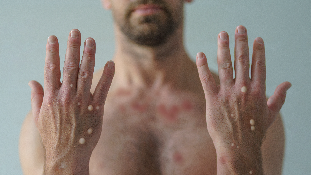 คำแนะนำป้องกันตัวจาก “ฝีดาษลิง” ย้ำพฤติกรรมแบบปกติ ความเสี่ยงแทบเป็น 0