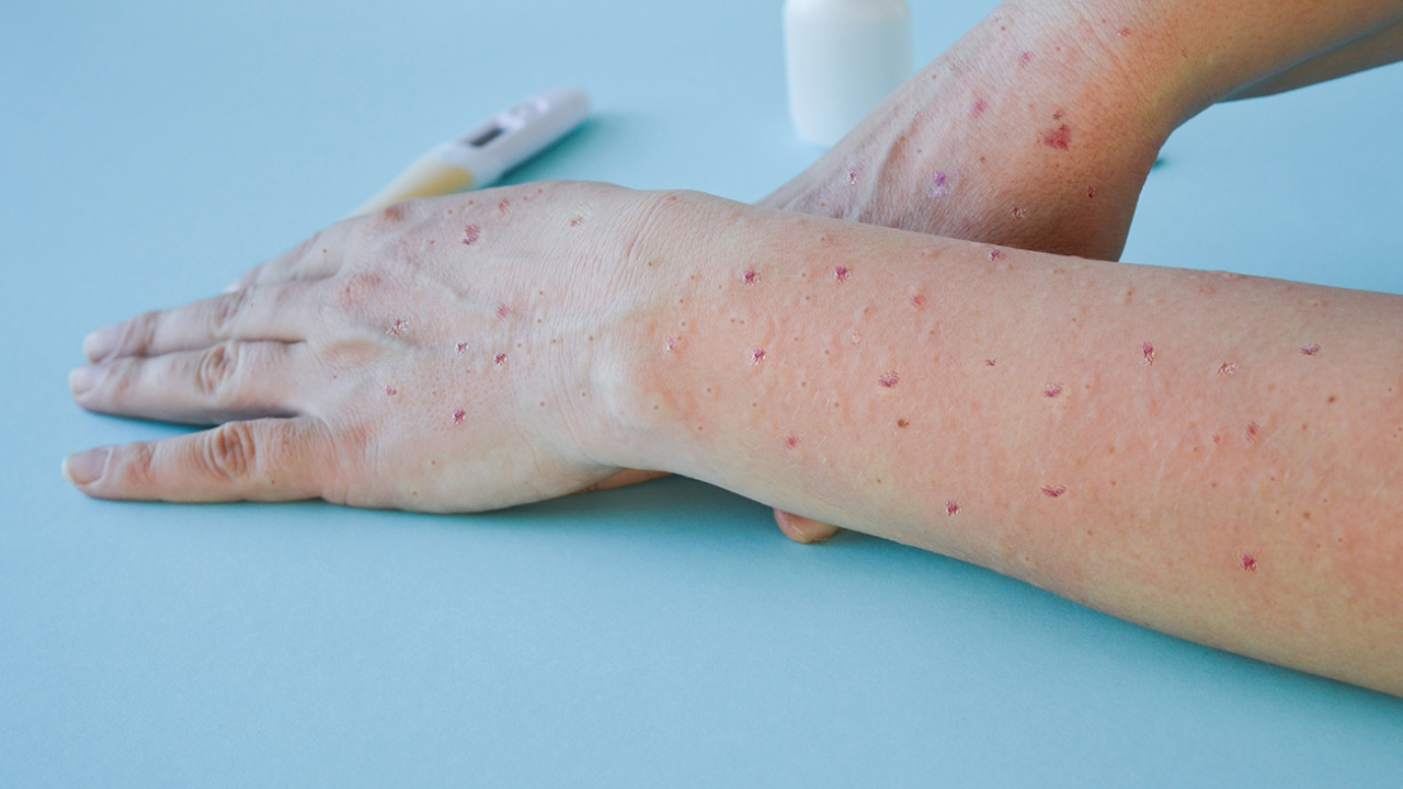 พบผู้ป่วย "ฝีดาษวานร" รายแรกของไทยที่ภูเก็ต เป็นชายไนจีเรียวัย 27 ปี