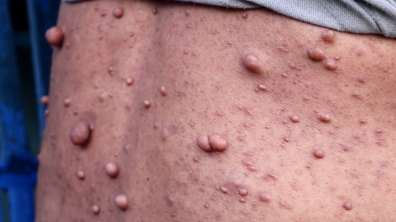 สาวป่วยท้าวแสนปม งดออกจากบ้าน ถูกมองด้วยสายตาหวาดระแวง 