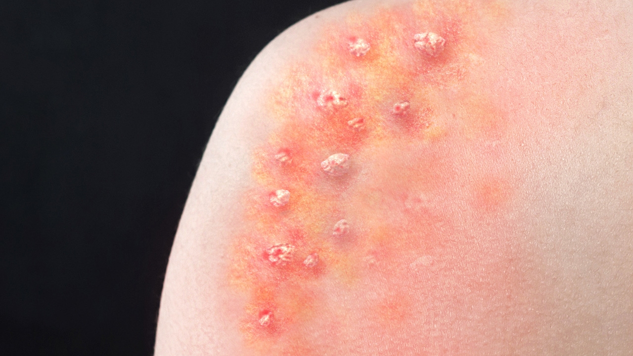 สธ.ตรวจหาเชื้อฝีดาษลิง กักตัว 13 คน เป็นกลุ่มเสี่ยง อย่าตื่นตระหนก