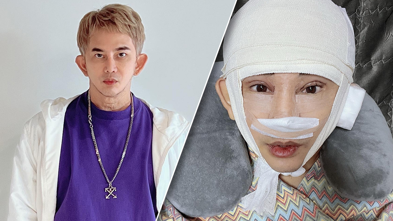 พชร์ อานนท์ โพสต์ภาพหลังศัลยกรรม ชอบมากหน้าเด็กลง 20 ปี ไม่แคร์คนบูลลี่