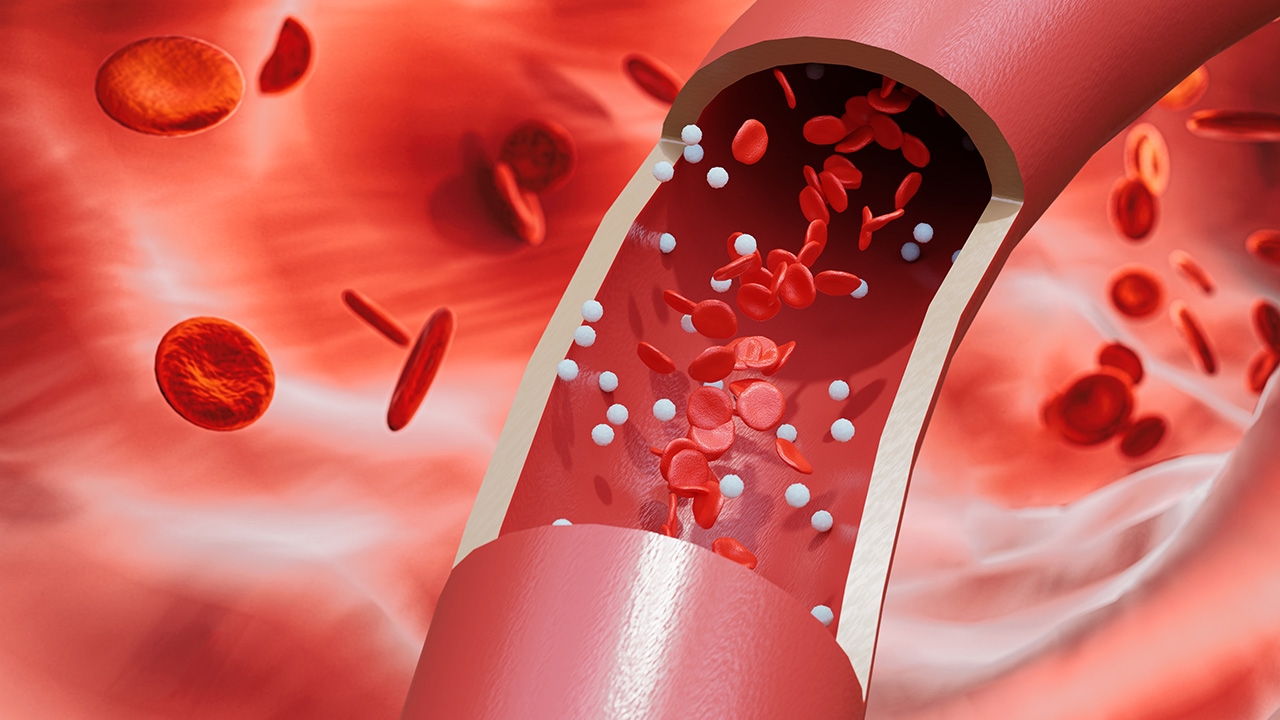 พบผู้ป่วย COVID-19 เสี่ยง..ภาวะลิ่มเลือดอุดตันในปอดสูงขึ้น