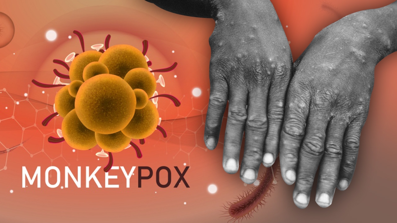 ฝีดาษลิง ระวังสัมผัสตุ่มหนอง เสี่ยงติดจากฉี่หรือไม่ ไทยลุ้นวัคซีนเชื้อเป็น