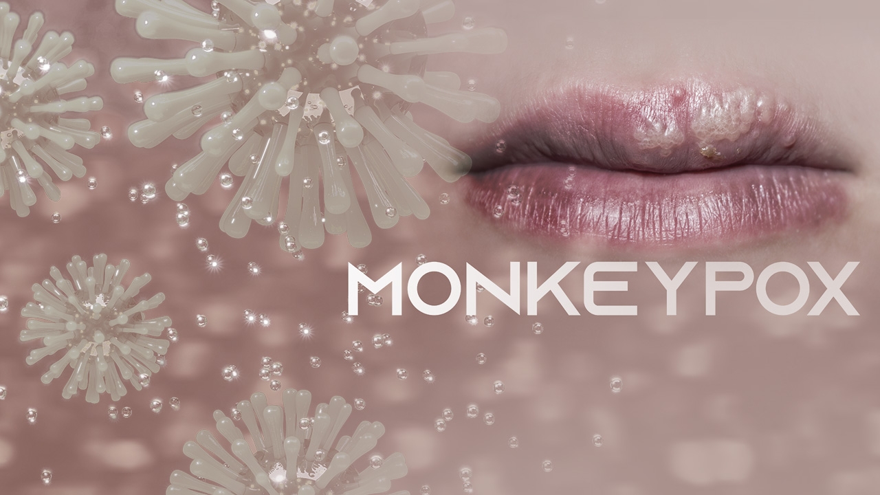 โรคฝีดาษลิง อาการเหมือนหรือต่างจาก โรคเริม อย่างไร 