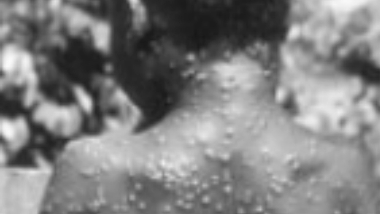 หมอเผย ผู้สูงอายุปลูกฝี 50 ปีก่อน สามารถป้องกัน "ฝีดาษลิง" ได้มากถึง 85%