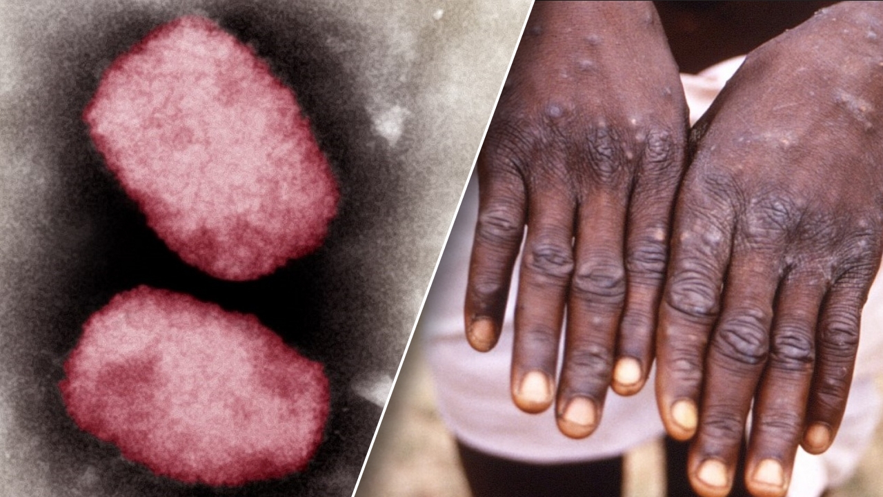 โซเชียลจีนแชร์กระหึ่ม ทฤษฎีสมคบคิด เชื่อสหรัฐฯ จงใจปล่อยเชื้อฝีดาษลิง 