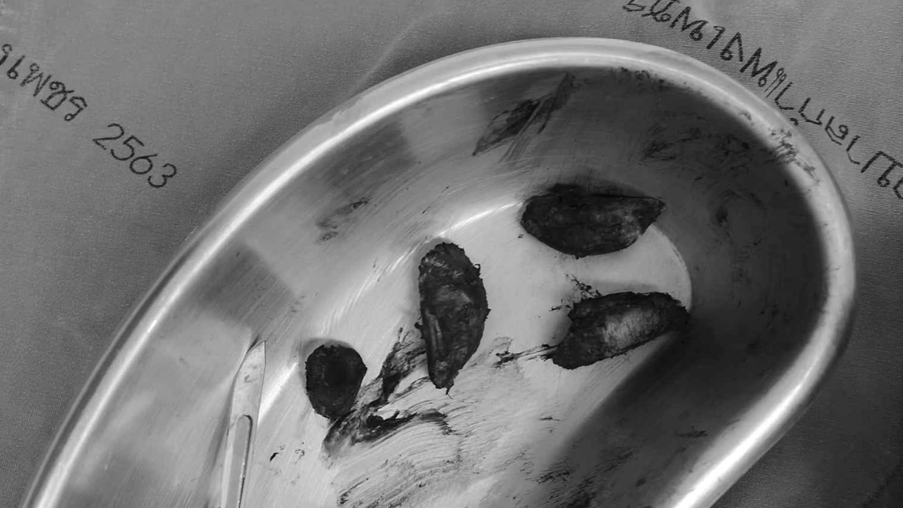 แพทย์เตือน กลืนเม็ดกระท้อน เสี่ยงลำไส้ทะลุ อันตรายถึงชีวิต