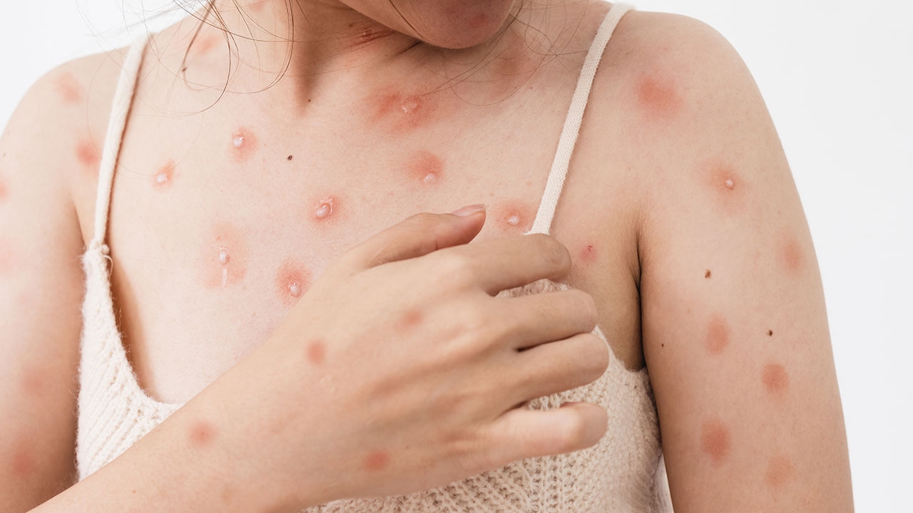 พบติดฝีดาษลิงอีก 2 คน สาวไทย-หนุ่มเยอรมัน ที่ภูเก็ต สะสม 10 คน