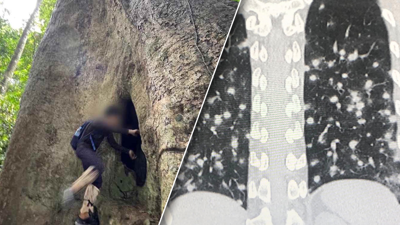 รู้จัก "โรคฮิสโตพลาสโมซิส" หลังคนเข้าไปในโพรงต้นไม้ 3 นาที ปอดอักเสบ