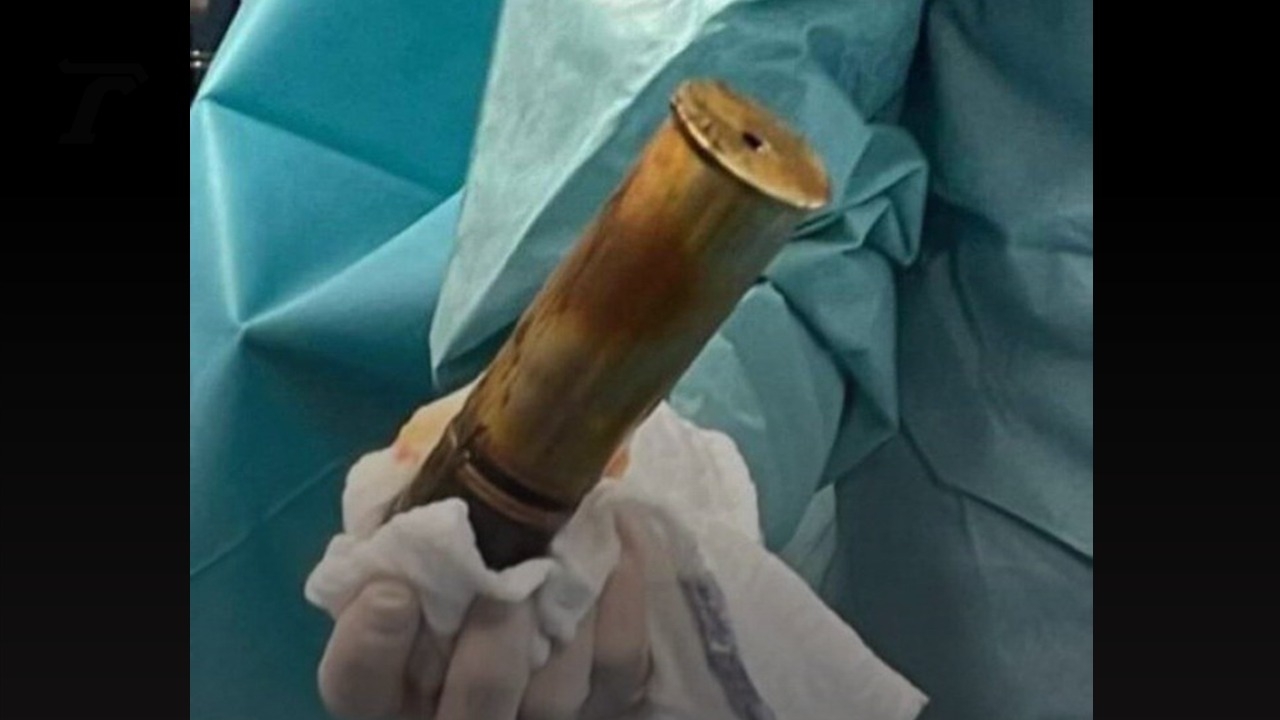 แตกตื่น หมอฝรั่งเศสเจอกระสุนปืนใหญ่ยุคสงครามโลก 1 ในทวารเฒ่าวัย 88 ปี