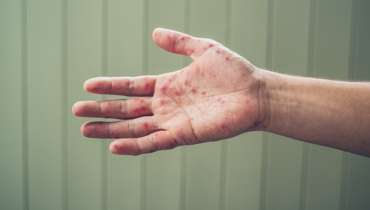 "โรคมือ เท้า ปาก" พ่อแม่ควรรู้...วิธีรับมือ