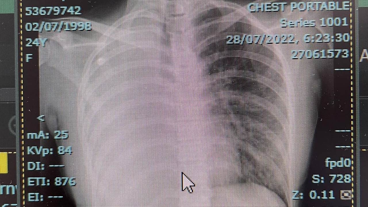 สาววัย 24 แชร์ประสบการณ์ป่วย "มะเร็งปอดระยะที่ 4" คาดสาเหตุอยู่ใกล้คนสูบบุหรี่