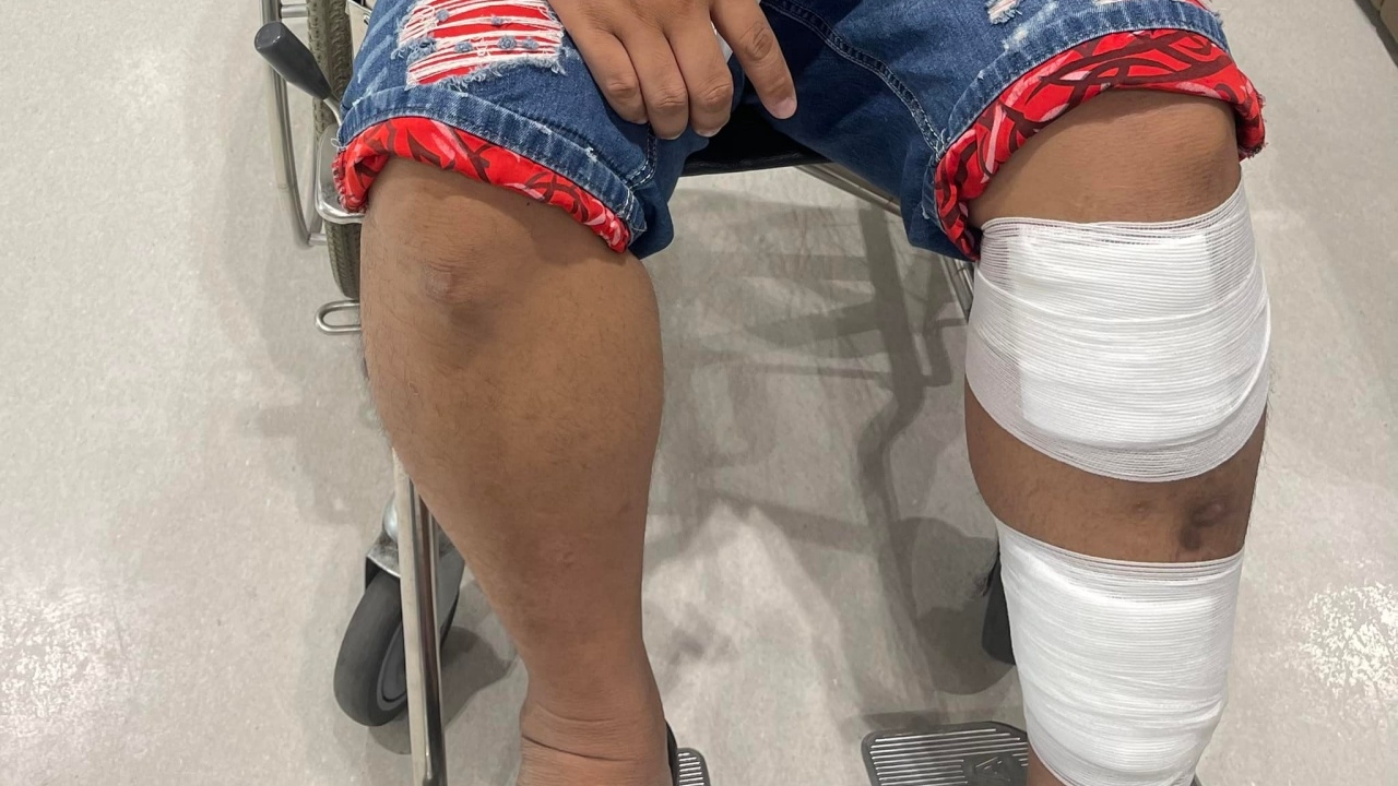 หนุ่มรีวิวที่พัก ก้าวเดียวพื้นแตก ร่วงทั้งขา รีสอร์ตเยียวยา แค่ 3,000