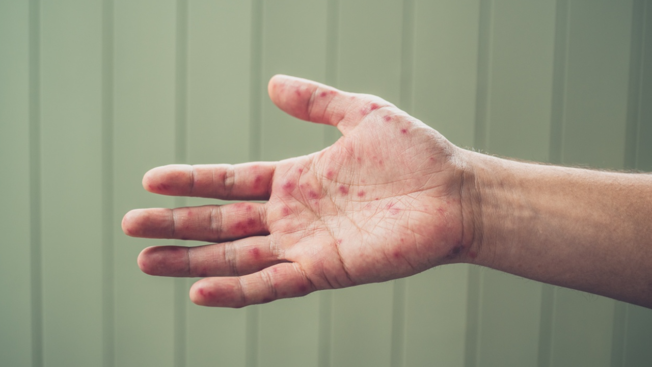 โรคมือ เท้า ปาก ป้องกันได้ด้วยวัคซีน