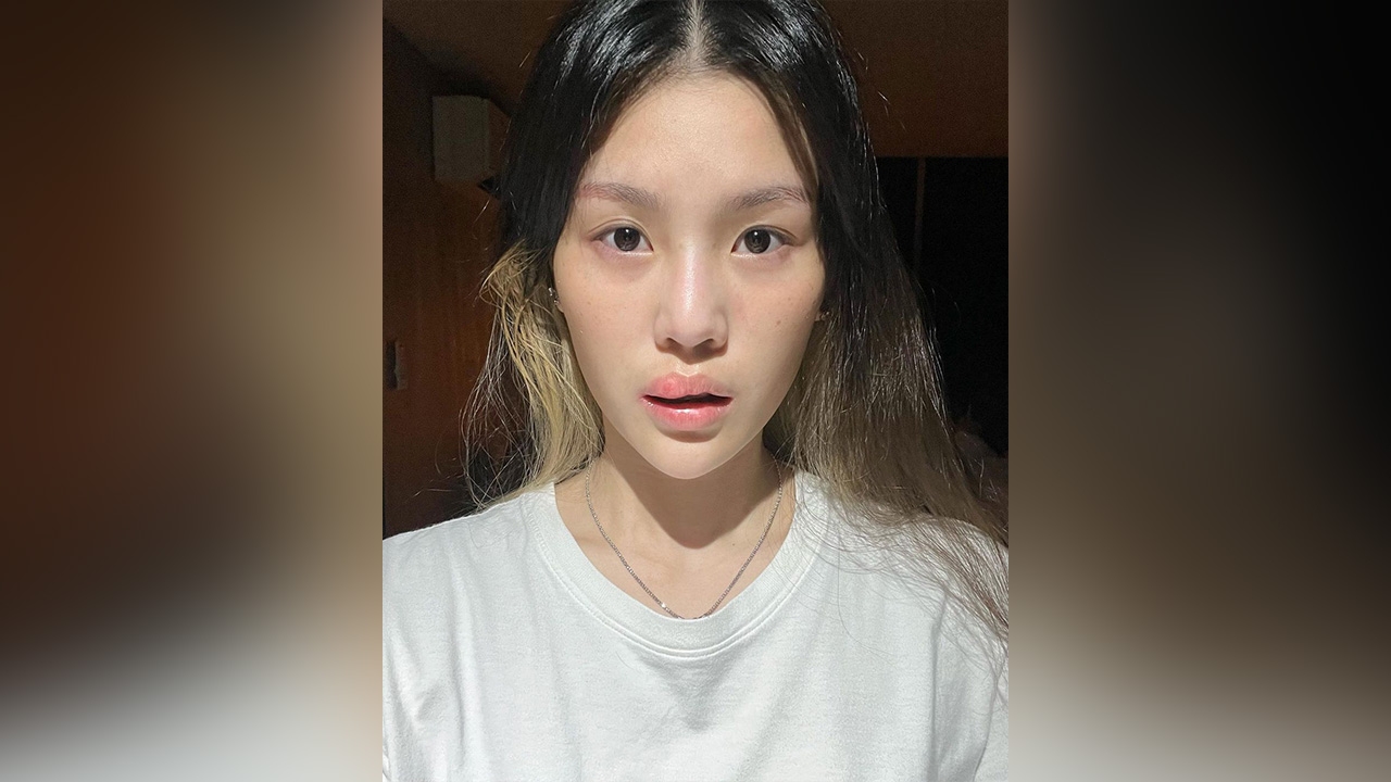 กร ภรรยา เป้ วงมายด์ โชว์ปากเละหลังฉีดฟิลเลอร์ สุดพีกก่อนเฉลยหมอคนไหนทำ