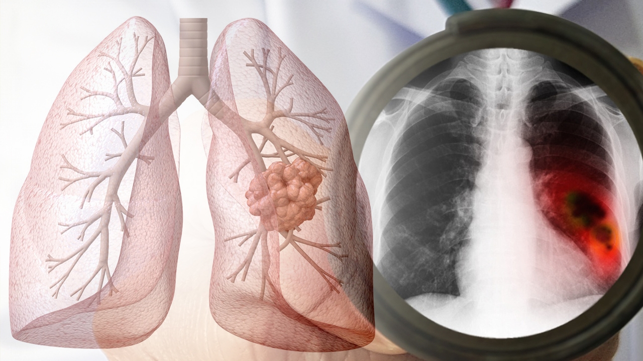 รักษาสุขภาพ ไม่สูบบุหรี่ ทำไมป่วยมะเร็งปอด ระวังภัยเงียบฝุ่น PM 2.5