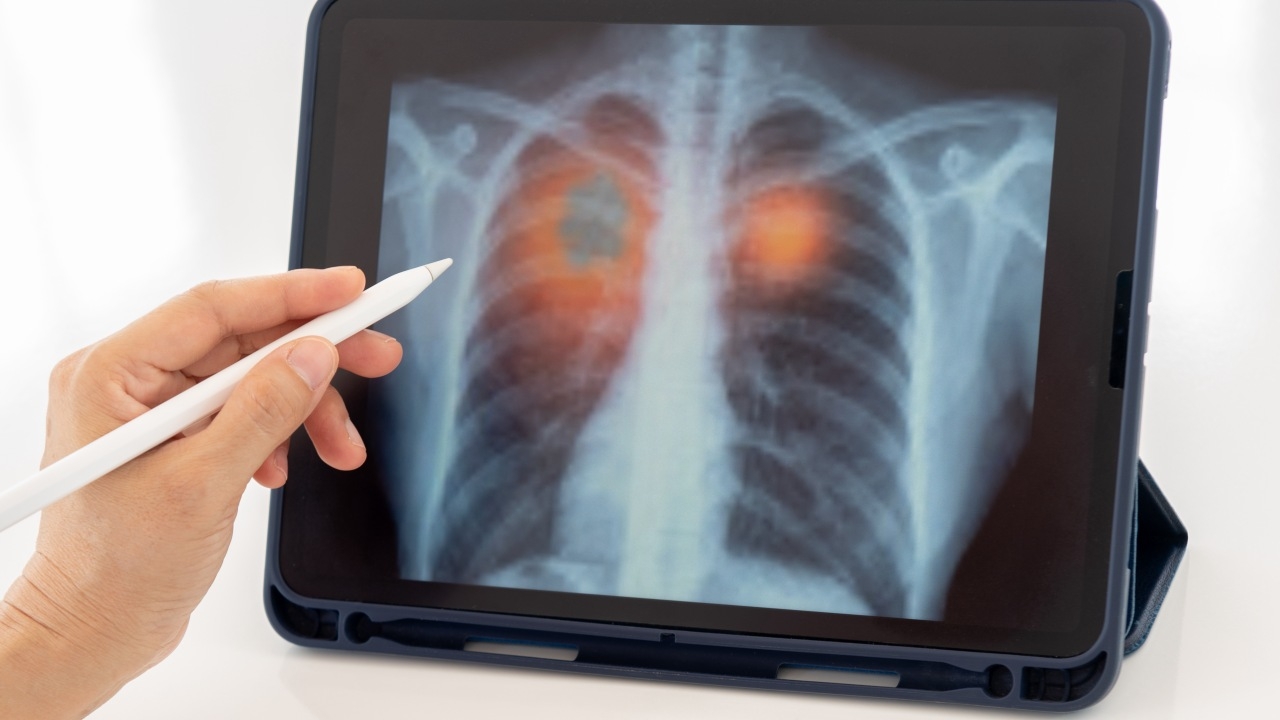 เช็กสัญญาณเตือน "มะเร็งปอด" แนะหลีกเลี่ยงปัจจัยเสี่ยงที่ก่อให้เกิดโรค