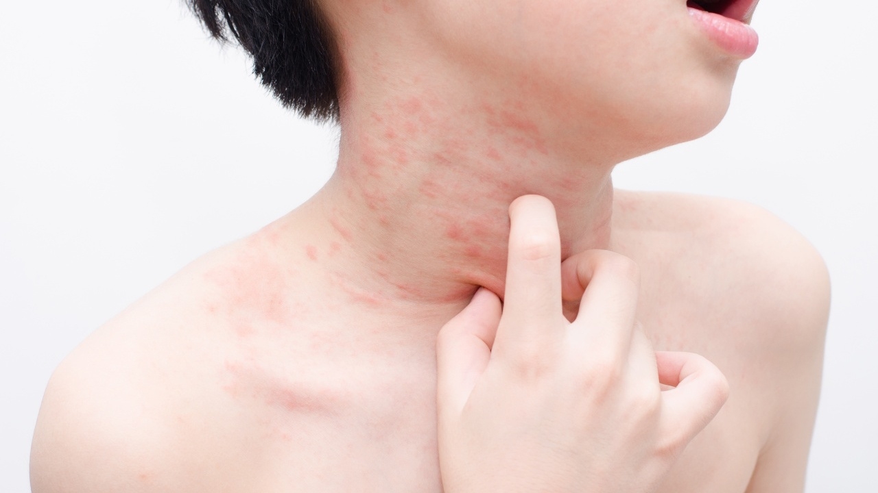 สารพันปัญหาผื่นในเด็ก