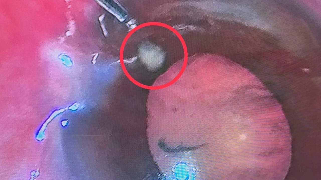 อุทาหรณ์ ใช้เครื่องตัดหญ้าสะพายไหล่ ไม่ป้องกัน เศษหินพุ่งฝังในเบ้าตา หวิดบอด