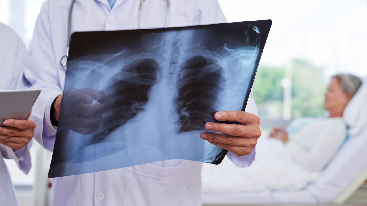 รู้จัก “อาการปอดติดเชื้อ” สาเหตุที่ทำให้ลินดา ค้าธัญเจริญ เสียชีวิต อันตรายแค่ไหน