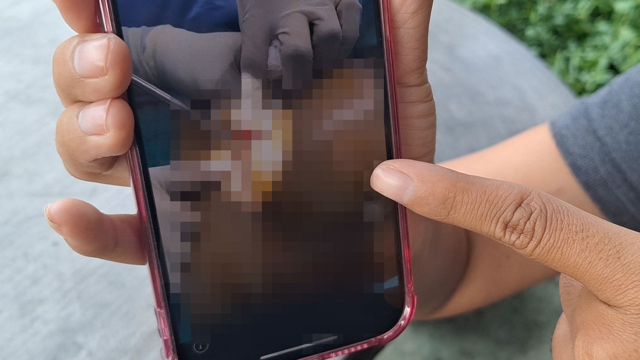 "ศัลยกรรมสยอง" สาวเสริมอึ๋มนมเน่า จี้คลินิกเยียวยา เคลียร์ไม่ลง-ถูกท้าฟ้อง