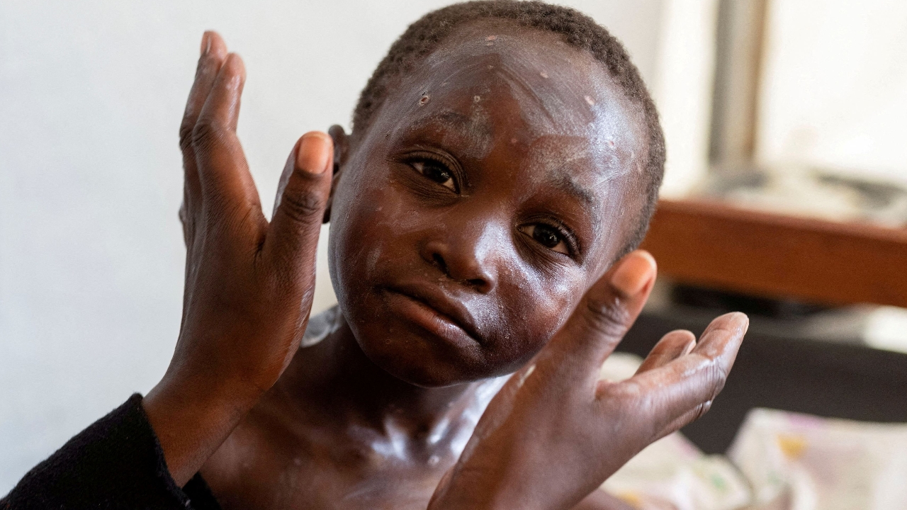 คองโกเผย คงไม่ได้รับวัคซีนฝีดาษลิงในสัปดาห์นี้ ตามที่องค์การอนามัยโลกเคยให้สัญญา