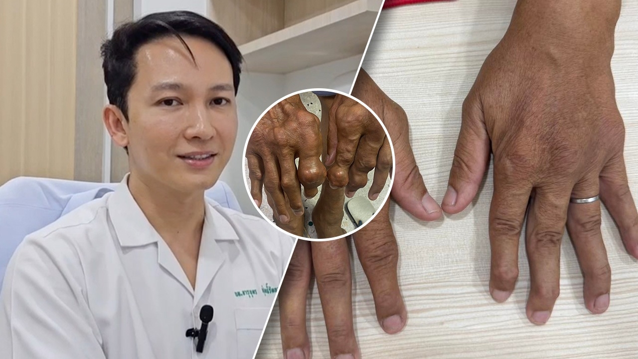 เปิดใจคุณหมอ รักษาผู้ป่วย "โรคเกาต์" มีก้อนขึ้นที่มือ-เท้า กว่า 5 ปีจนหายดี