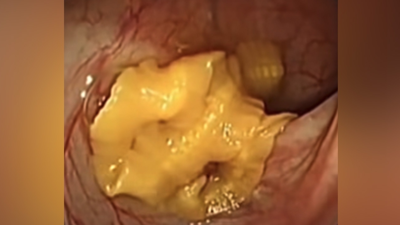 เตือนสายกินดิบ หญิงคันทวารหนัก ตรวจเจอพยาธิตืดปลา เคลื่อนไหวในลำไส้