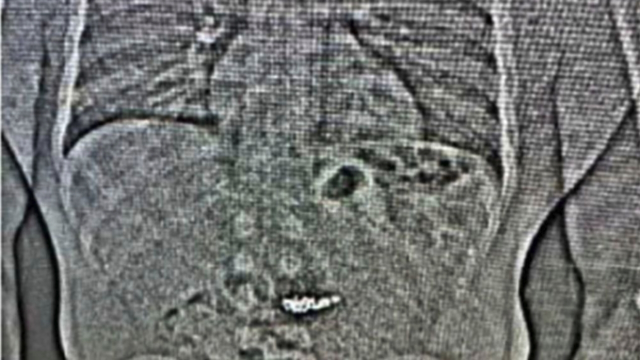 โจรปล้นร้านเพชรกลืนต่างหูเพชร มูลค่ากว่า 25 ล้านบาทลงท้อง หวังรอดการจับกุม