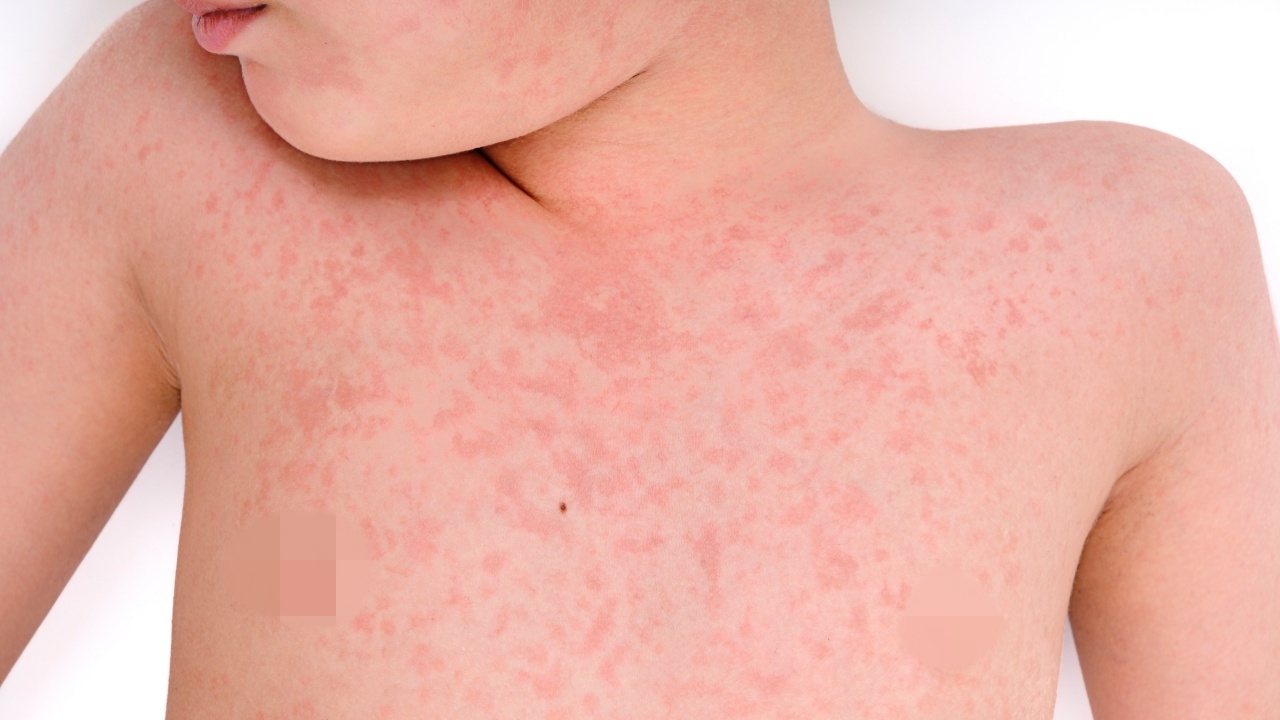 จับตาโรคหัดระบาดในสหรัฐฯ ล่าสุดมีเด็กเสียชีวิตรายแรกในรอบหลายปี