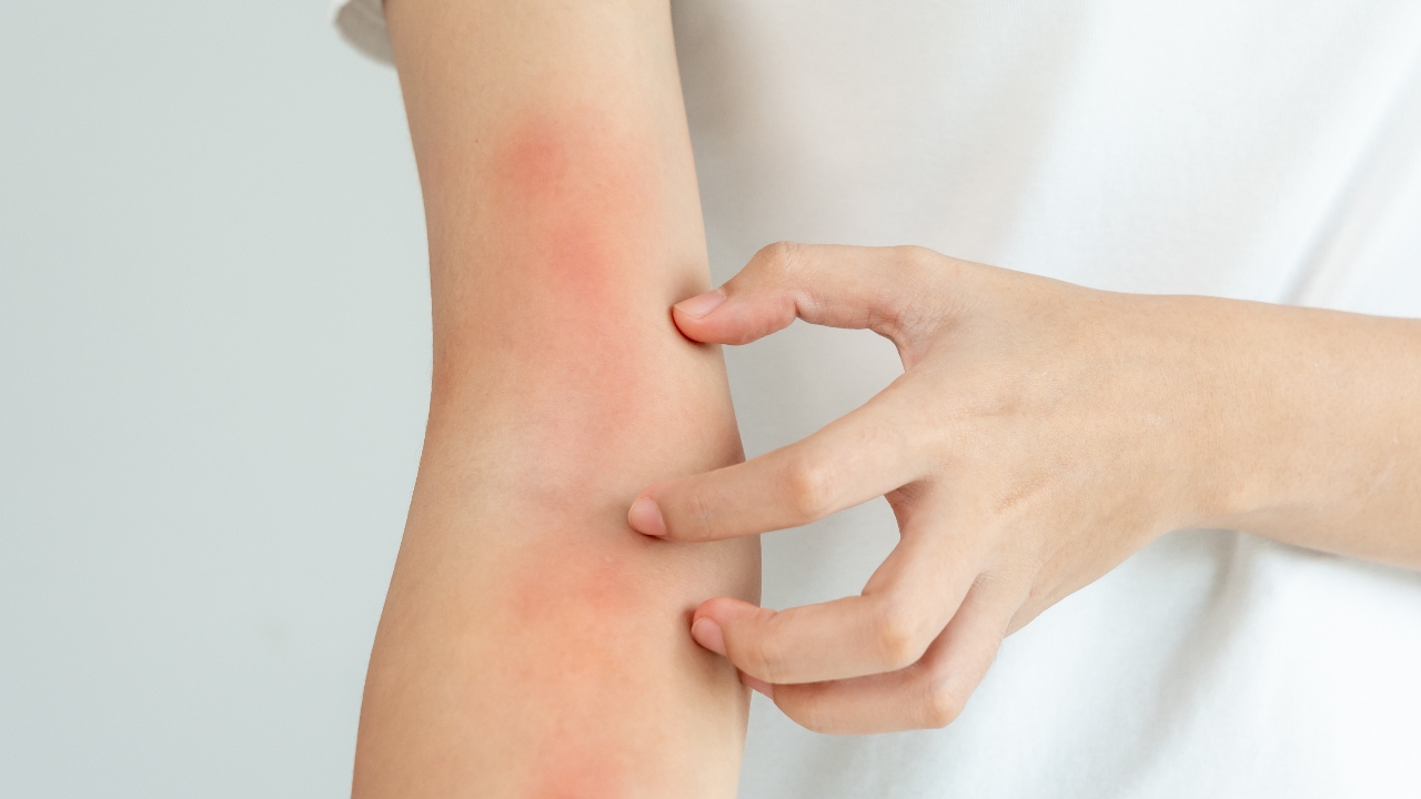 “โรคลมพิษ” เป็นแล้ว…ต้องรับมือให้เป็น