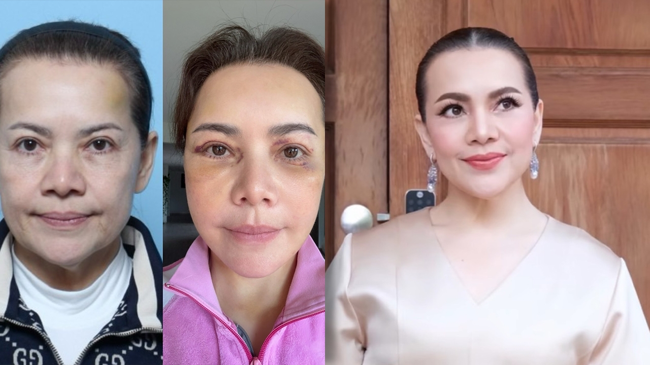 ว้าวมาก เปิดภาพ หนูแหม่ม สุริวิภา หลังทำศัลยกรรมยกหน้าใหม่ในวัย 58 ปี