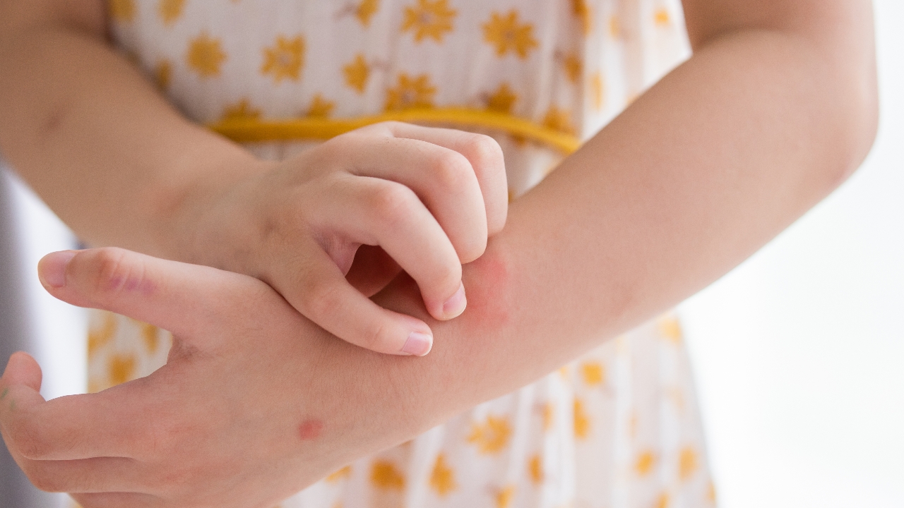 รู้จัก ‘ลมพิษในเด็ก’ โรคผิวหนังที่ผู้ปกครองไม่ควรมองข้าม