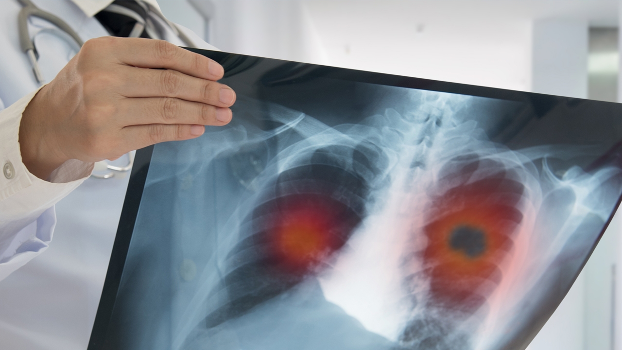 การรักษามะเร็งปอดในปัจจุบัน