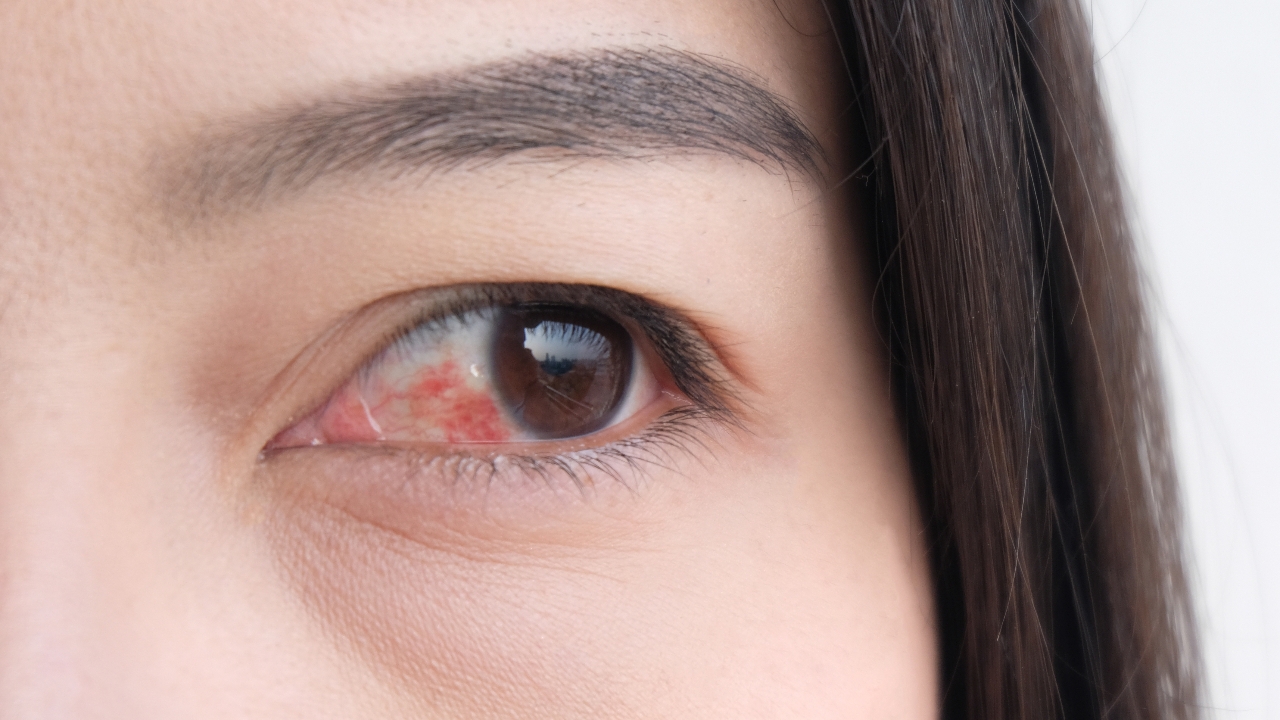 ตาแดงธรรมดา vs. ตาแดงติดเชื้อ แยกยังไงดี? รู้ไว้ก่อนเล่นน้ำสงกรานต์