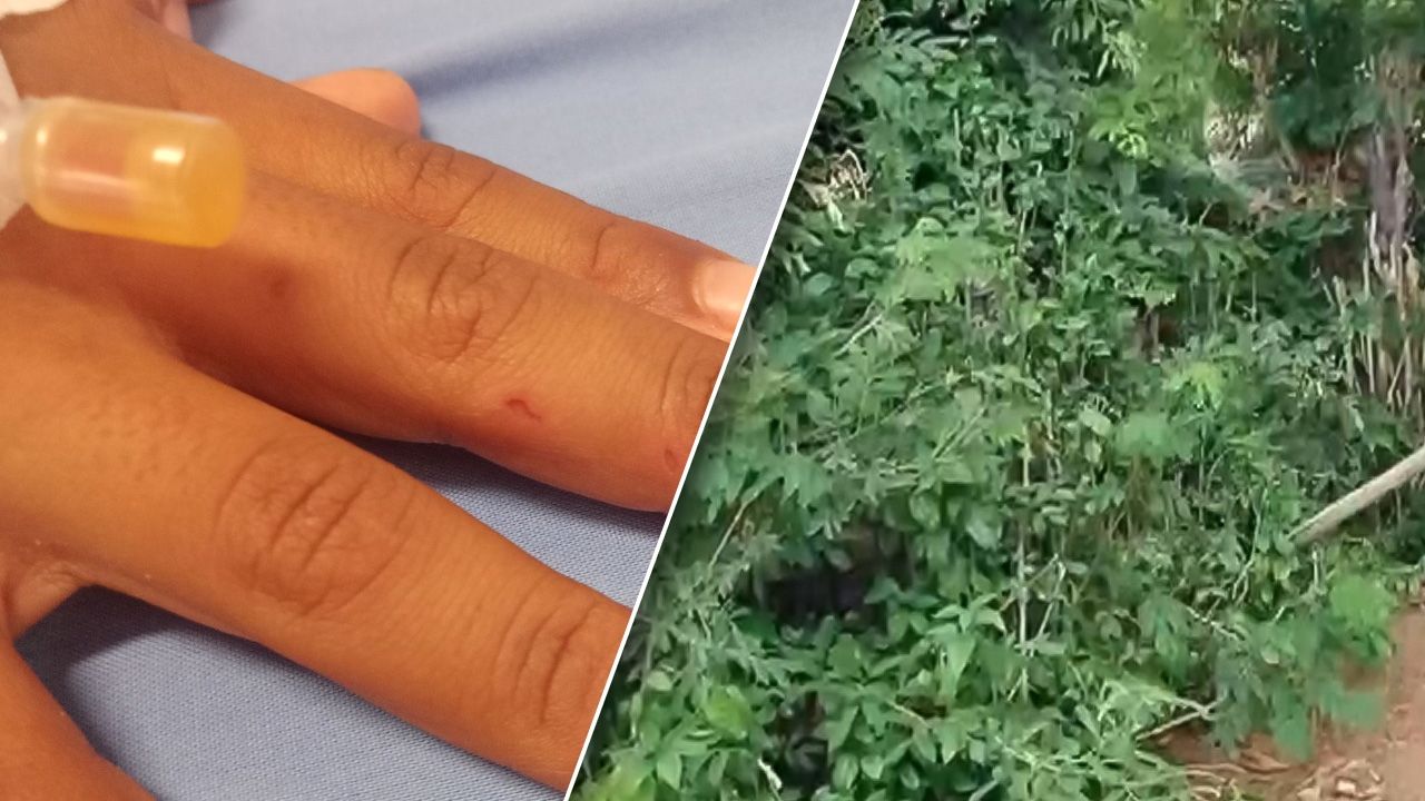 แม่แชร์อุทาหรณ์ ลูกวัย 7 ขวบ เล่นซ่อนหาแถวพุ่มไม้รก สุดท้ายเจองูมีพิษฉกมือ