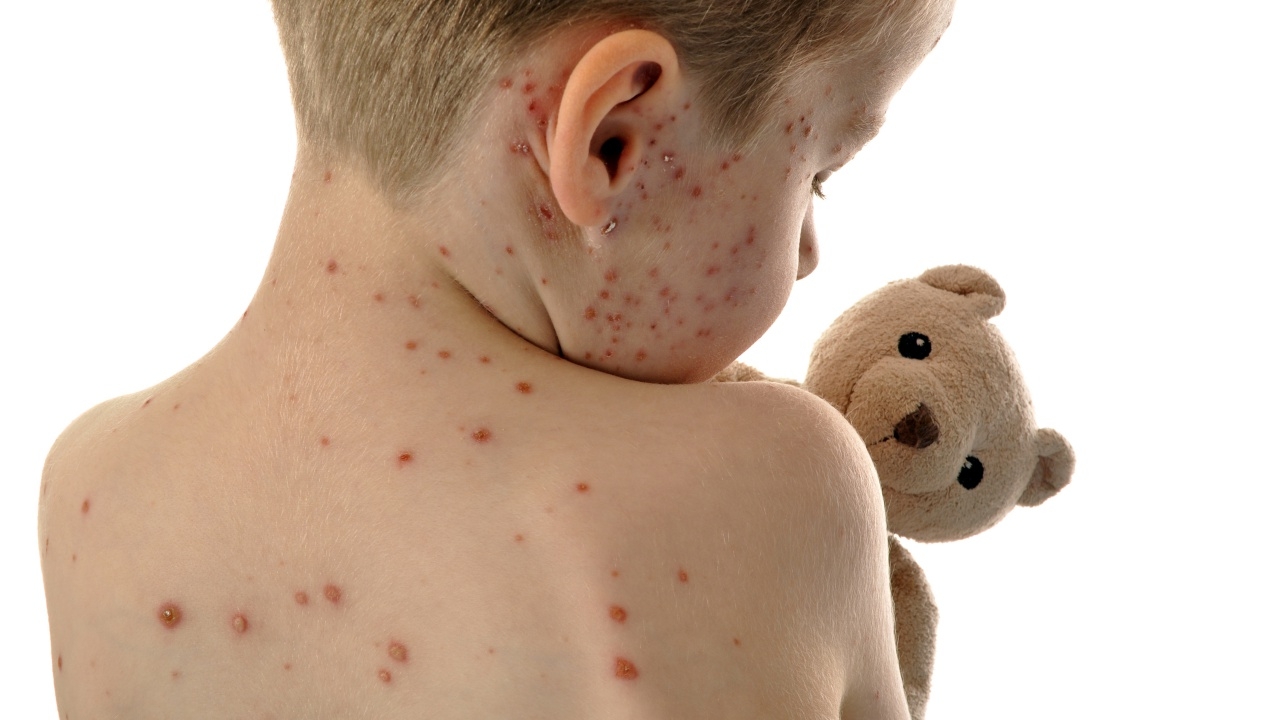 สหรัฐฯ พบผู้ป่วยโรคหัดทะลุ 1,000 ราย ครั้งแรกในรอบ 5 ปี