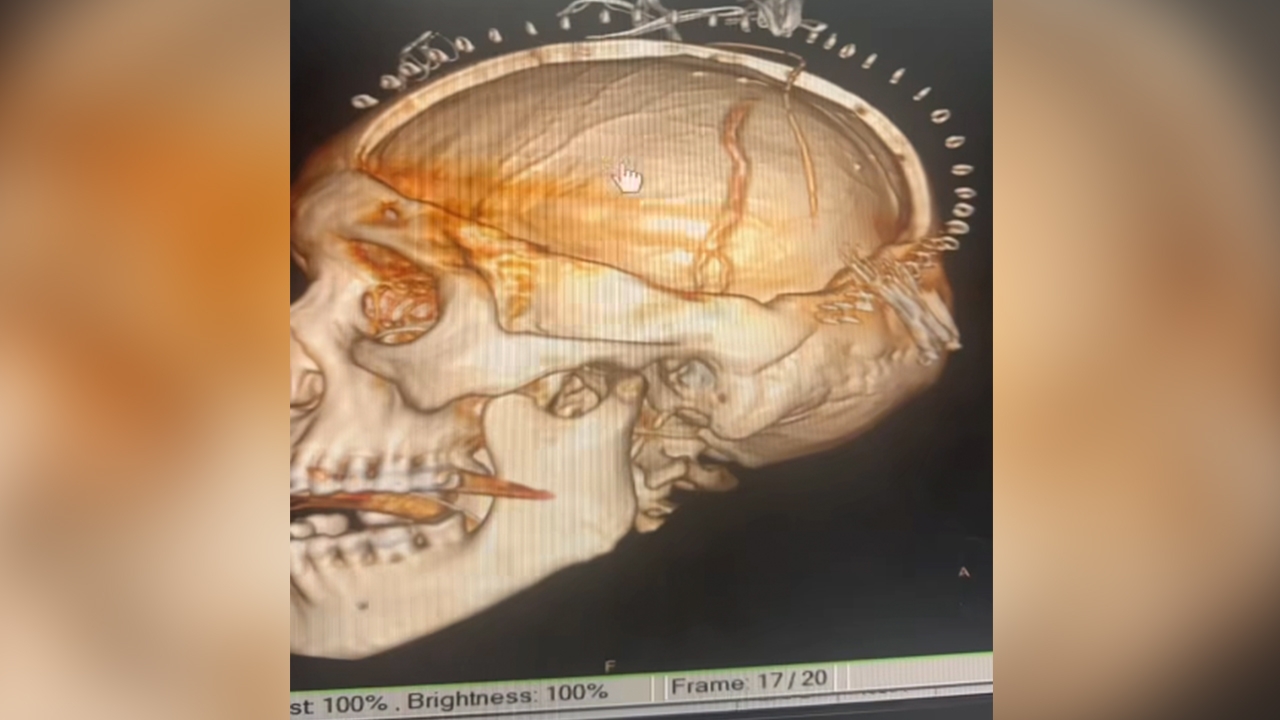 แพทย์แชร์อุทาหรณ์ ผัวให้เมียนวดต้นคอ กดผิด เส้นเลือดที่คอปริแตก-สมองตาย