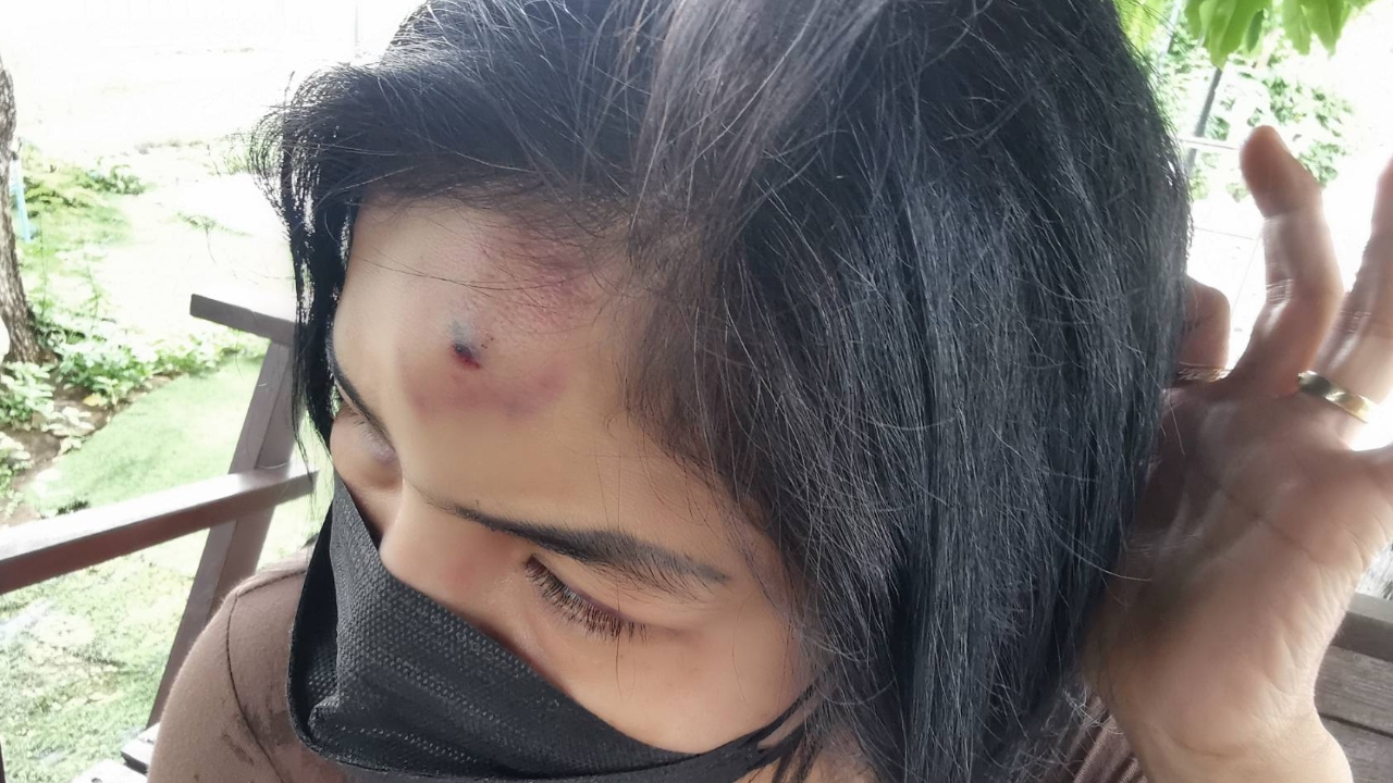 สาวโดนซ้อมน่วม แจ้งความคนรักวัย 39 โอดทำอะไรก็ผิด กินกับข้าวเยอะก็โดนตบ