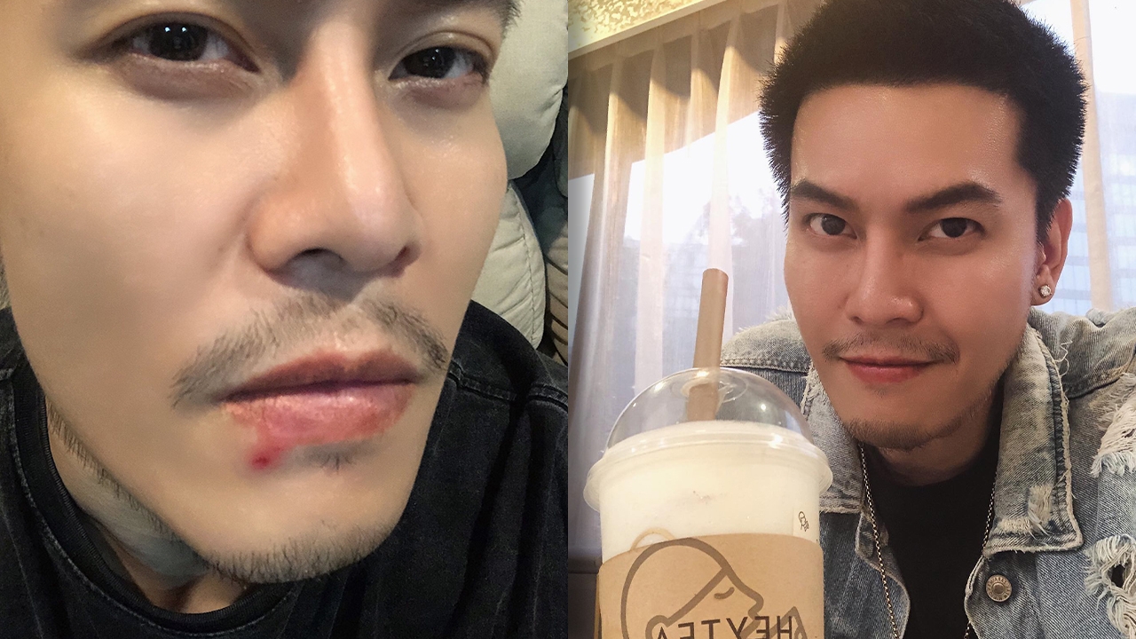 ดิว เดอะสตาร์ 4 เตือนใช้ไมโครโฟนที่ไม่สะอาด เสี่ยงเป็นต่อมน้ำเหลืองใต้คางอักเสบ