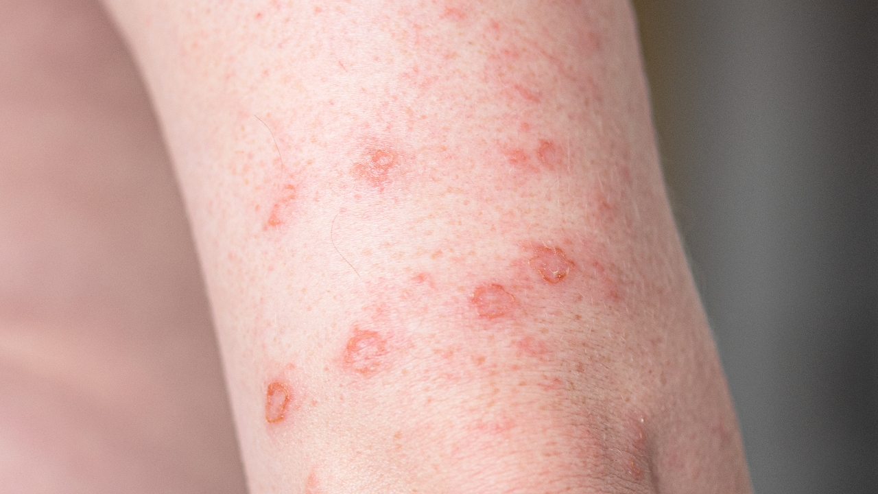 อย่าตระหนก แจงข่าวเตือนซิฟิลิสระบาด ในหมู่นักศึกษา 2 วันเจอ 3 รายพ่วง HIV