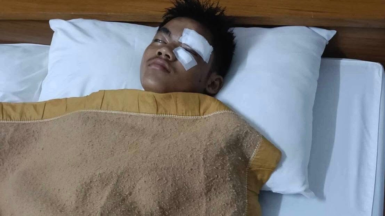 หายไวๆ “นักมวยไทย” กระดูกเบ้าตาซ้ายแตก ยืนทรงตัวไม่ได้ อาเจียนเป็นพักๆ